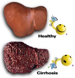 cirrhosis.jpg