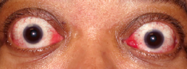 exophthalmos-view-1.png