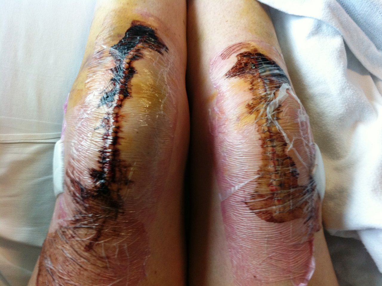 how-long-does-swelling-last-after-total-knee-replacement-surgery-1.jpg