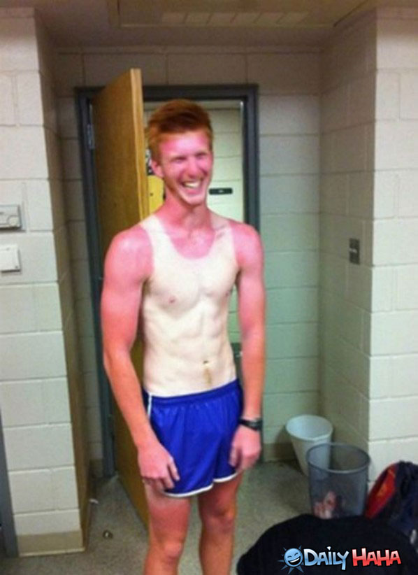 one-amazing-sun-burn1.jpg