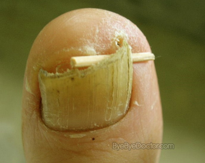 ingrown-toenail-5.jpg