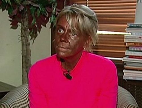 Caso-extremo-Tanorexia.jpg